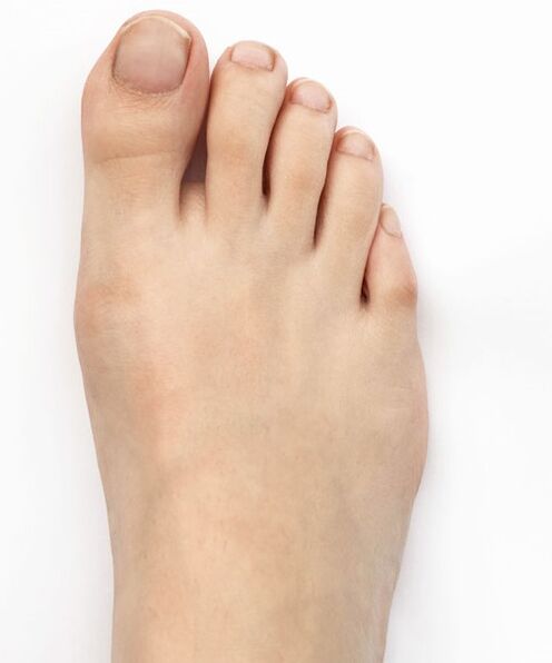 Es izārstēju īkšķi valgus ar Hondro Sol Valgus aerosolu