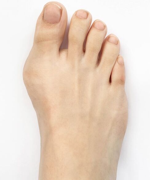 hallux valgus pirms Hondro Sol Valgus aerosola lietošanas