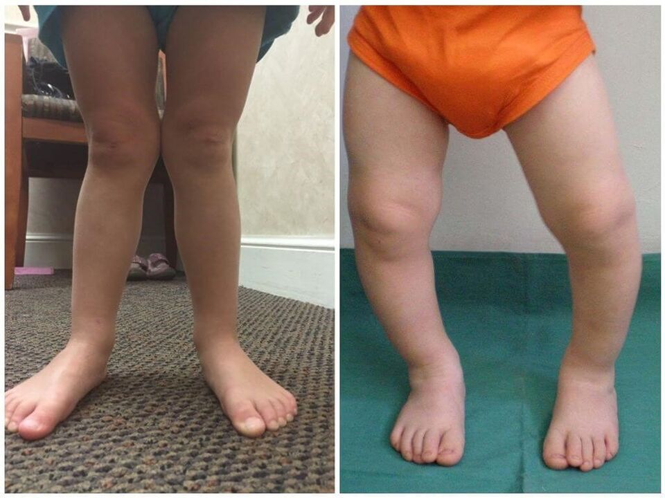 Valgus deformācija bērniem izraisa