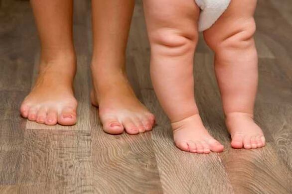 Valgus deformācija bērniem