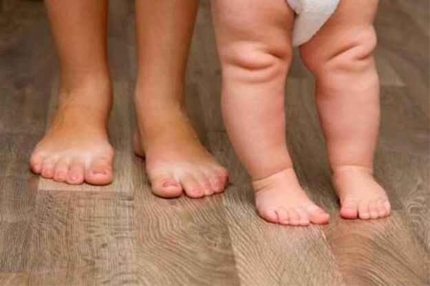 Valgus deformācija
