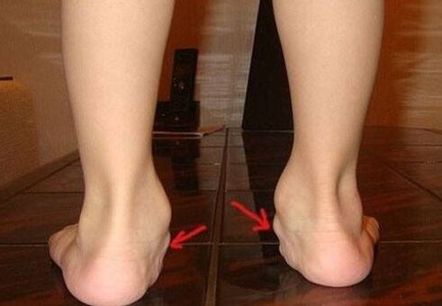 Bērnu pēdu deformācija valgus