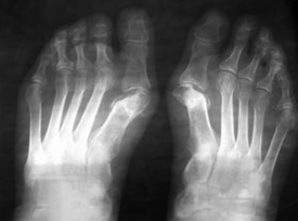 Norādes operācijām zem pēdas valgus