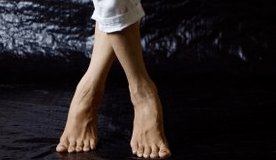 Valgus deformācija