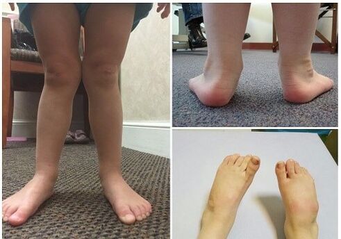 Valgus deformācija bērniem