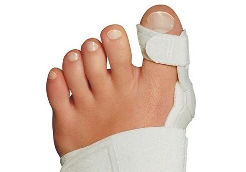 Valgus deformācija