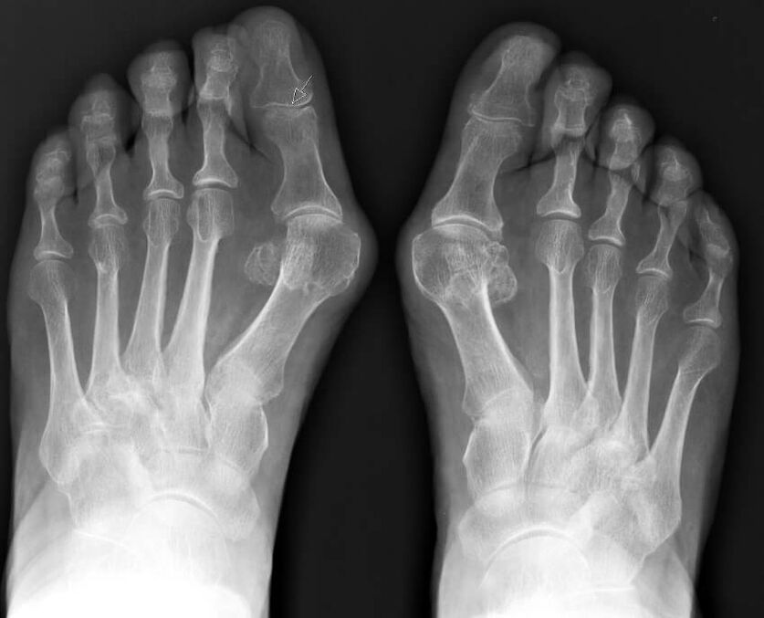 Hallux valgus rentgens